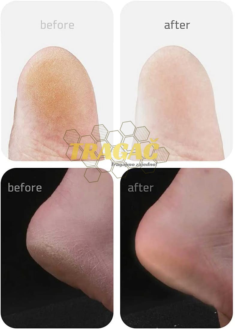 Električna turpija za noge - Callus remover vacuum